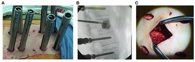 Freehand Minimally Invasive Pedicle Screw Fixation and Minimally Invasive Decompression for a Thoracic or Lumbar Vertebral Metastatic Tumor From Hepatocellular Carcinoma